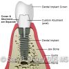 A Cemnet Retained Implant Crown A Cemnet Retained Implant Crown