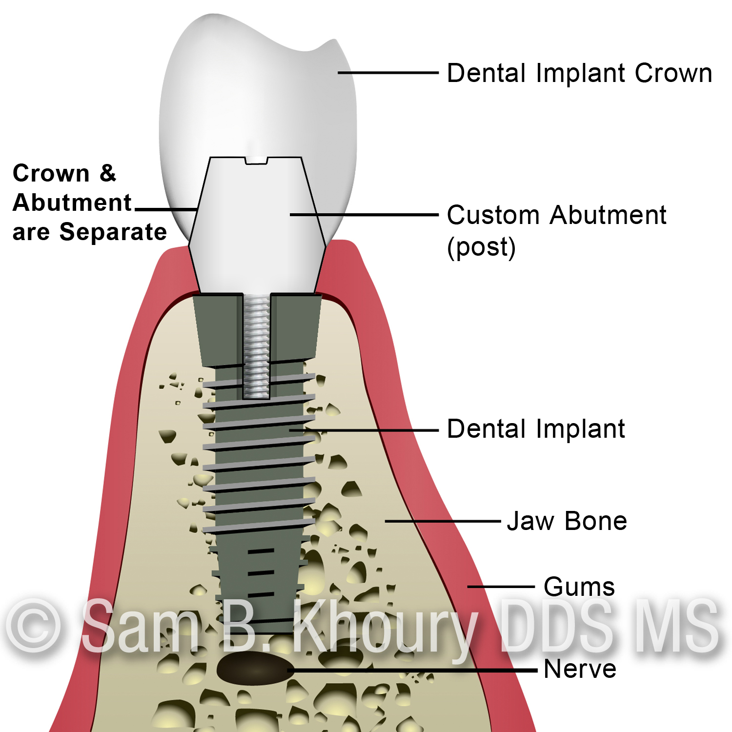 A Cemnet Retained Implant Crown