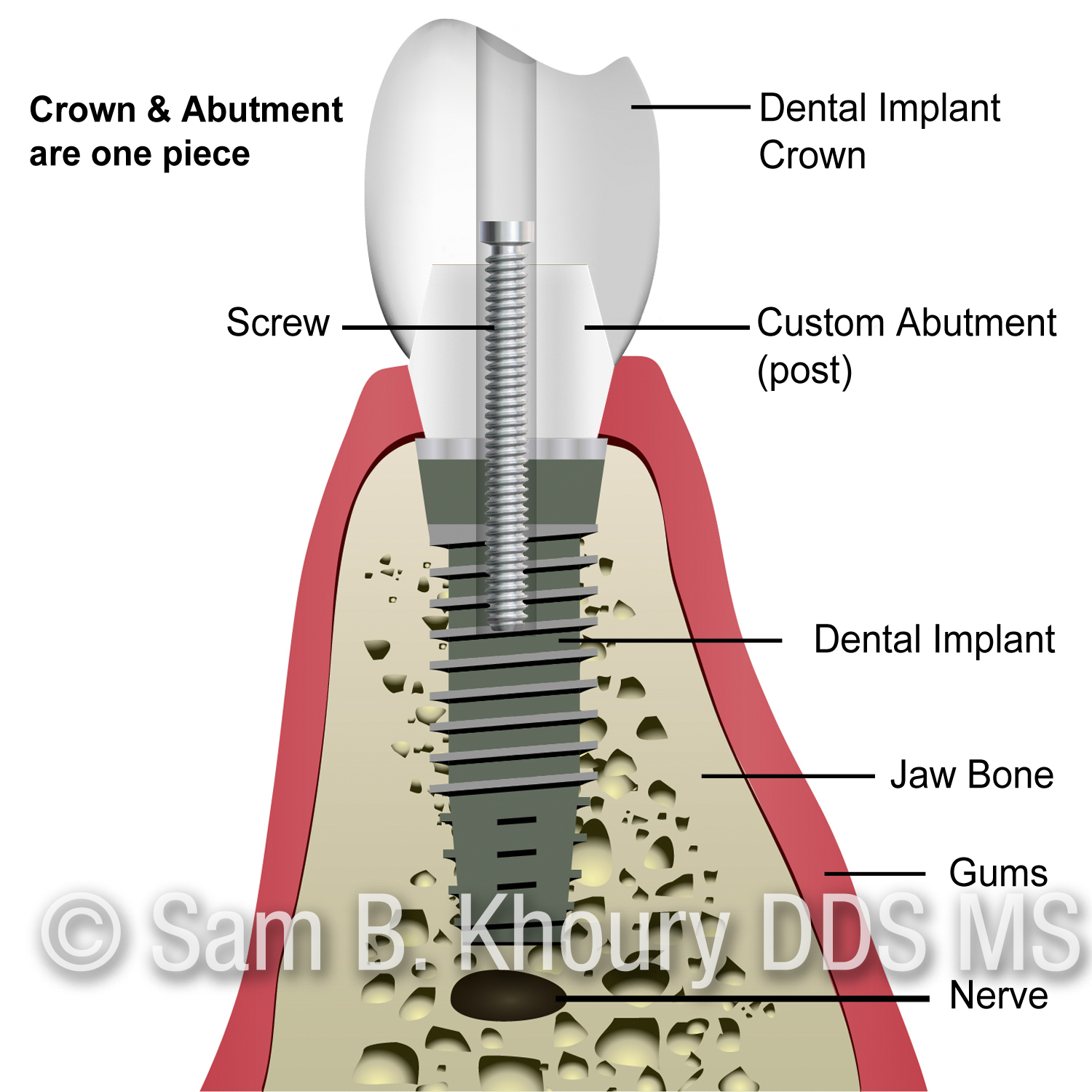 A Screw retained implant crown
