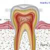 Gum Disease Stage-1 Gum Disease Stage-1