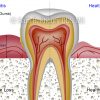Gum Disease Stage-2 Gum Disease Stage-2