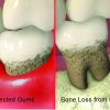 Gum Disease Stage-5 Gum Disease Stage-5