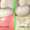 Gum Disease Stage-6 Gum Disease Stage-6