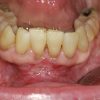 Image 4-Frenectomy Image 4-Frenectomy
