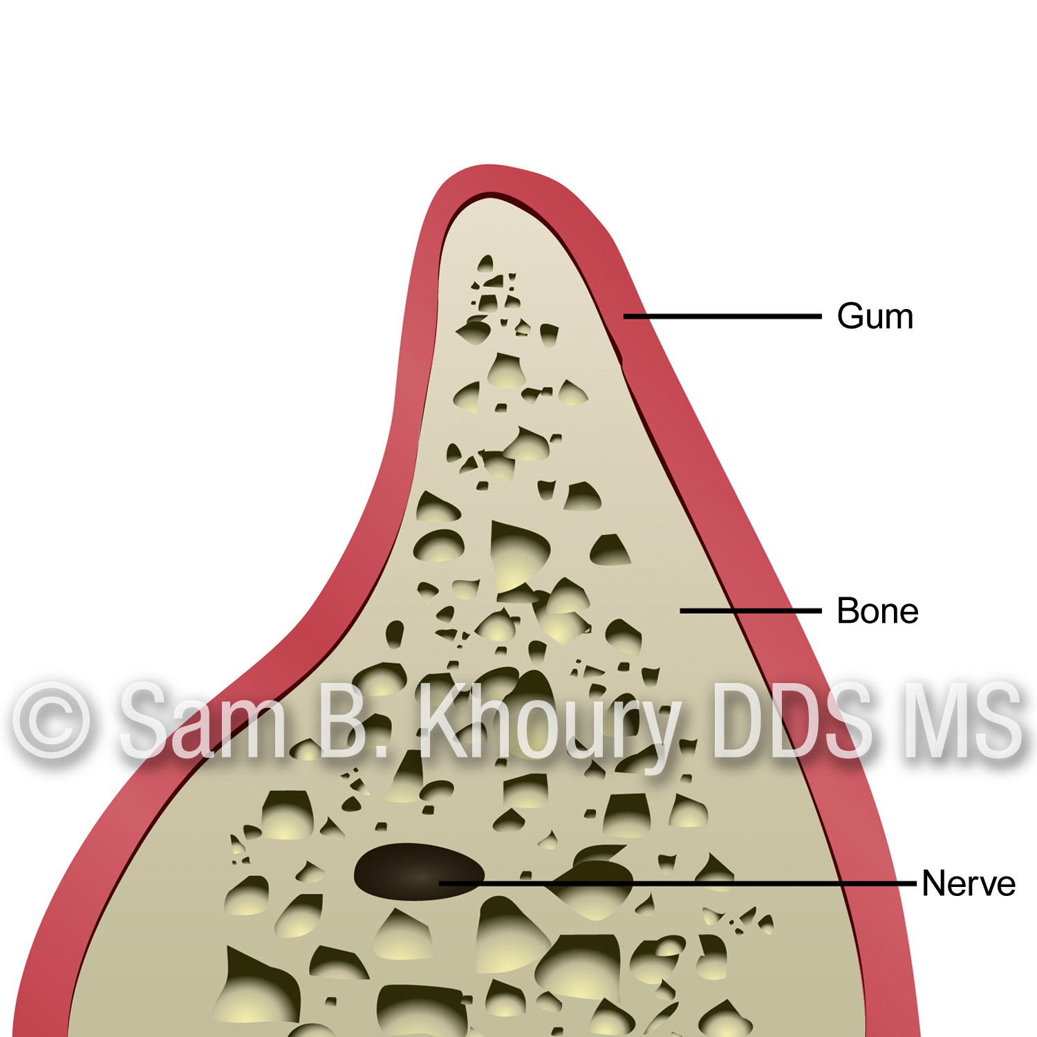 Jaw Augmentation 1