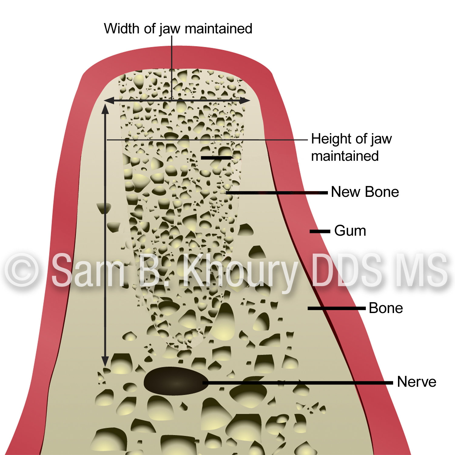 Jaw dimension 2