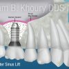Sinus Lift 3-Implant Sinus Lift 3-Implant