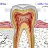 Bone grafting 2