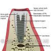 Immediate implant-2