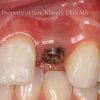 2-single-implant-dental-implant-placed