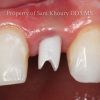 3-single-implant-abutment_preview-1