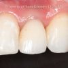4-single-implant-final-implant-crown