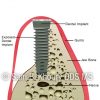 Jaw-Augmentation-2_preview